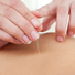 acupuncture cheshire